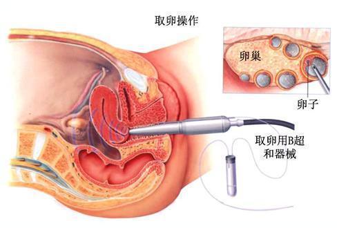 揭秘试管婴儿全过程（附图）